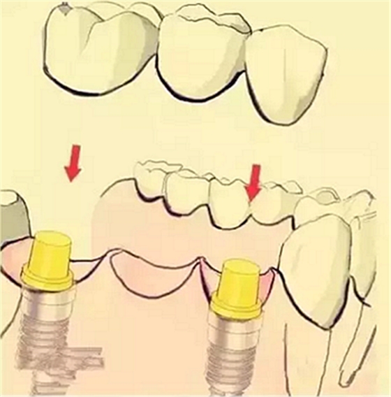 【牙齒種植】健康牙齒“種”出來 【牙齒種植】健康牙齒“種”出來