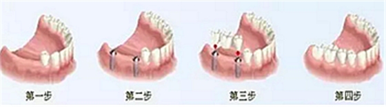 【牙齒種植】健康牙齒“種”出來 【牙齒種植】健康牙齒“種”出來