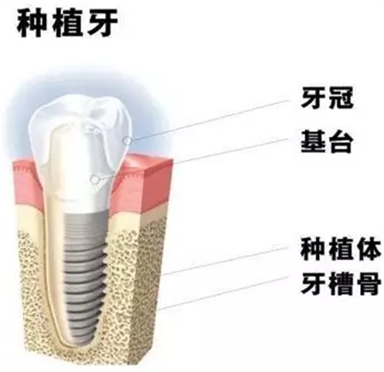 種植牙會松動的原因是什么？