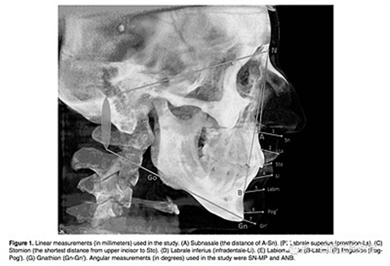 正畸文獻(xiàn)閱讀--使用CBCT評(píng)估具有不同垂直生長(zhǎng)模式的成人患者的面下1/3的軟組織厚度值