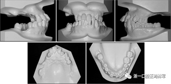 文獻優(yōu)秀正畸病例賞析--多顆牙齒缺失的牙周炎患者的跨學科綜合治療