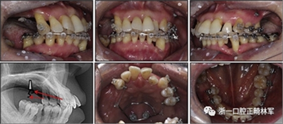 文獻優(yōu)秀正畸病例賞析--多顆牙齒缺失的牙周炎患者的跨學科綜合治療