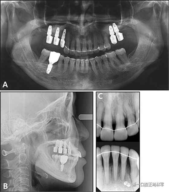 文獻優(yōu)秀正畸病例賞析--多顆牙齒缺失的牙周炎患者的跨學科綜合治療