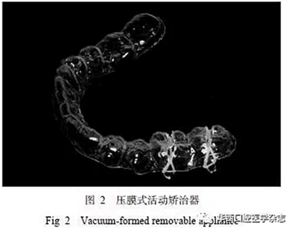 利用壓膜式活動矯治器壓入下頜第一、第二磨牙1例