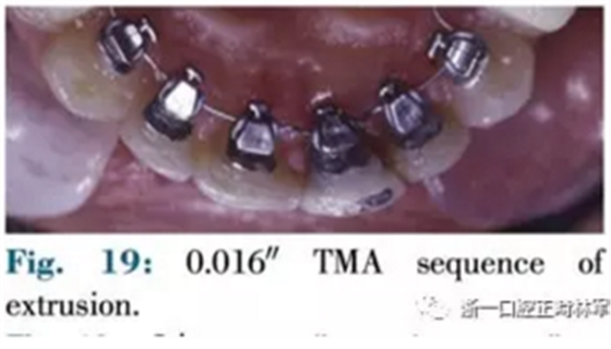 文獻(xiàn)優(yōu)秀正畸病例賞析--正畸牙周聯(lián)合治療方法病例介紹