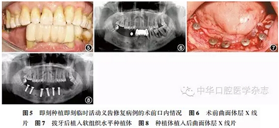 【專家筆談】即刻種植治療方案的評估與實施