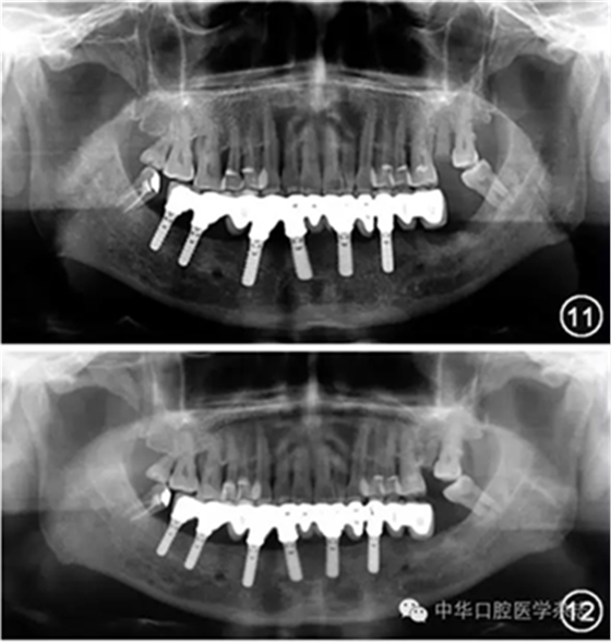 【專家筆談】即刻種植治療方案的評估與實施