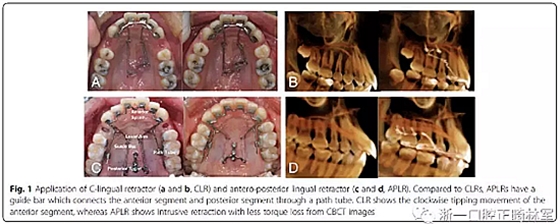 正畸文獻閱讀--用舌側(cè)滑動牽引系統(tǒng)控制前牙區(qū)段：初步的CBCT研究