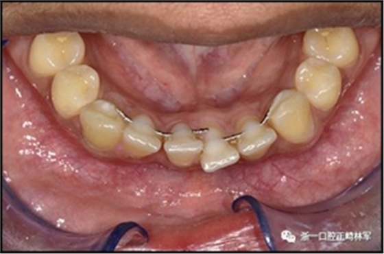 正畸文獻閱讀--固定舌側(cè)保持器作用下意外的牙齒移動