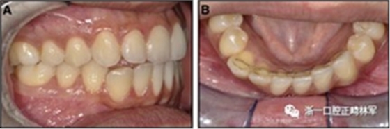 正畸文獻閱讀--固定舌側(cè)保持器作用下意外的牙齒移動