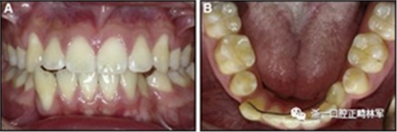 正畸文獻閱讀--固定舌側(cè)保持器作用下意外的牙齒移動