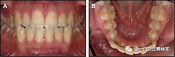 正畸文獻閱讀--固定舌側(cè)保持器作用下意外的牙齒移動