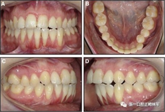 正畸文獻閱讀--固定舌側(cè)保持器作用下意外的牙齒移動