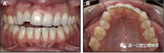 正畸文獻閱讀--固定舌側(cè)保持器作用下意外的牙齒移動