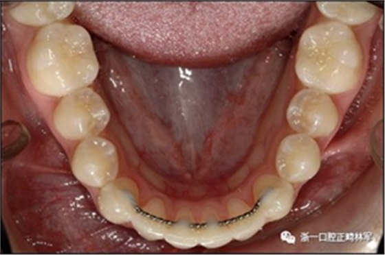 正畸文獻閱讀--固定舌側(cè)保持器作用下意外的牙齒移動