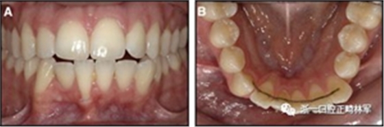 正畸文獻閱讀--固定舌側(cè)保持器作用下意外的牙齒移動
