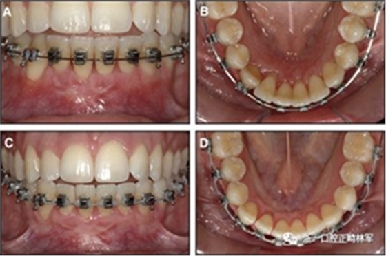 正畸文獻閱讀--固定舌側(cè)保持器作用下意外的牙齒移動