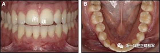 正畸文獻閱讀--固定舌側(cè)保持器作用下意外的牙齒移動