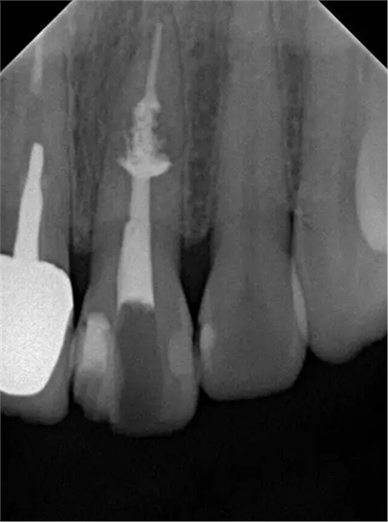 伴隨根管內(nèi)鈣化物形成牙根內(nèi)吸收治療1例