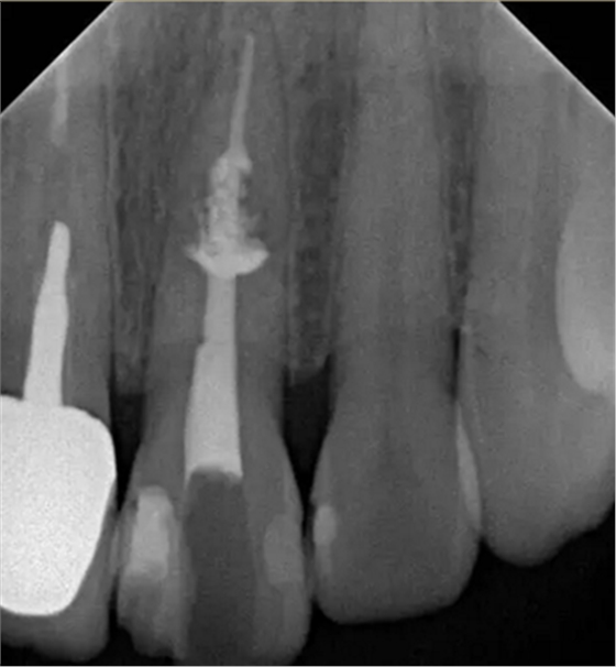 伴隨根管內(nèi)鈣化物形成牙根內(nèi)吸收治療1例