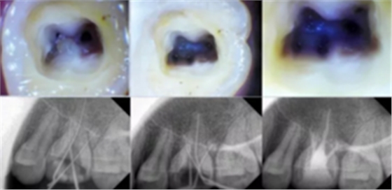 知識(shí)分享：根管治療的標(biāo)準(zhǔn)步驟