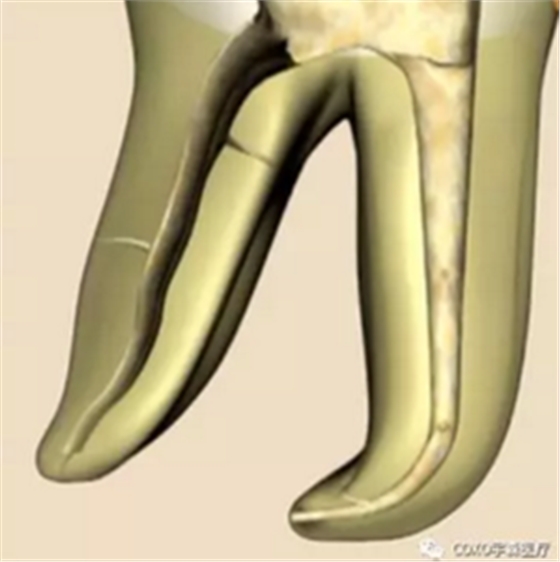 知識(shí)分享：根管治療的標(biāo)準(zhǔn)步驟