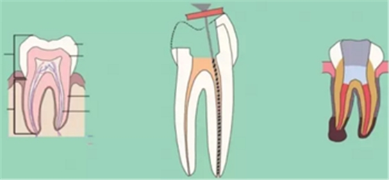 知識(shí)分享：根管治療的標(biāo)準(zhǔn)步驟