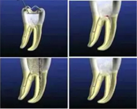知識(shí)分享：根管治療的標(biāo)準(zhǔn)步驟