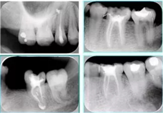 知識(shí)分享：根管治療的標(biāo)準(zhǔn)步驟