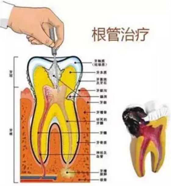 醫(yī)生，牙齒折斷不是應(yīng)該補上去嗎，為啥要做根管治療？