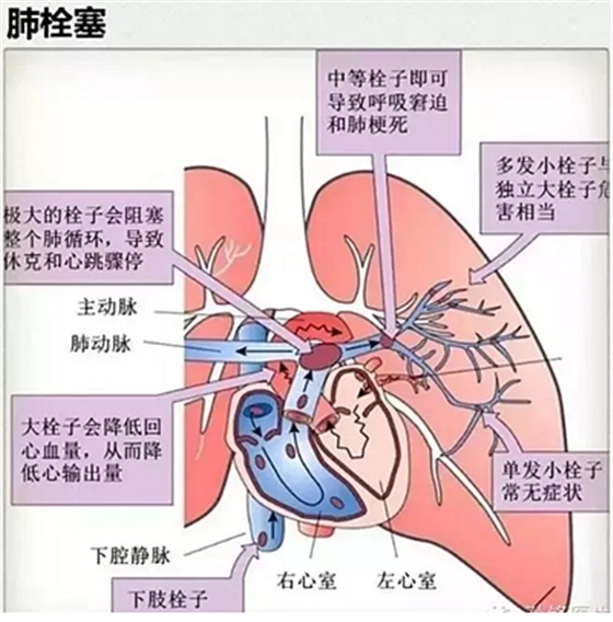 牙醫(yī)要注意！3％雙氧水口腔內(nèi)沖洗致氣體栓塞