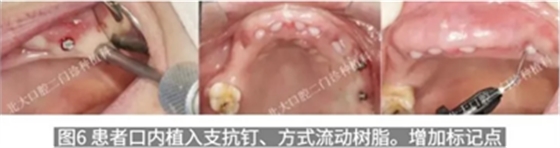 病例報(bào)道│全程數(shù)字化輔助無(wú)牙頜種植即刻負(fù)重