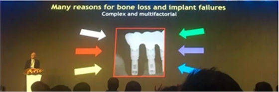 【聽課筆記】種植體周圍骨吸收因素研究與臨床意義