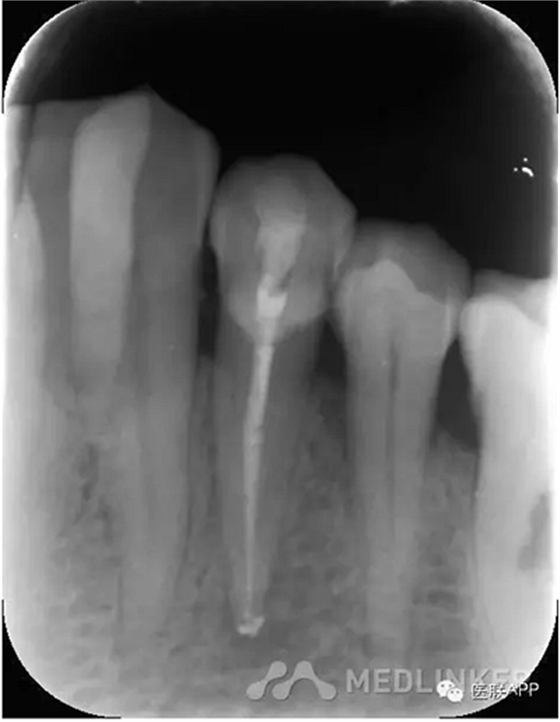 楔狀缺損導(dǎo)致根尖周炎