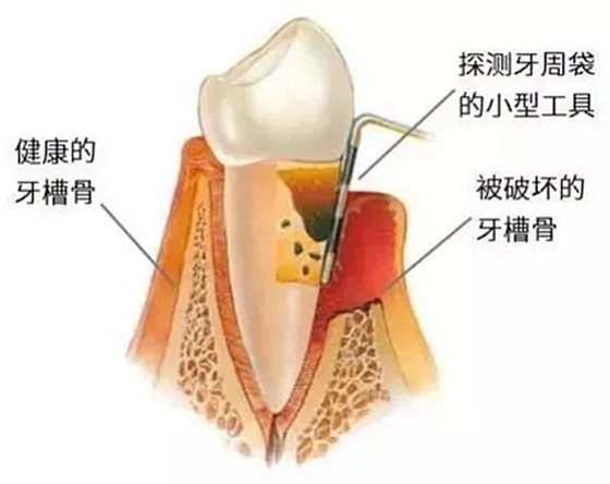 上海嘉?？谇谎芯克皇兰o(jì)牙周病的臨床進(jìn)展