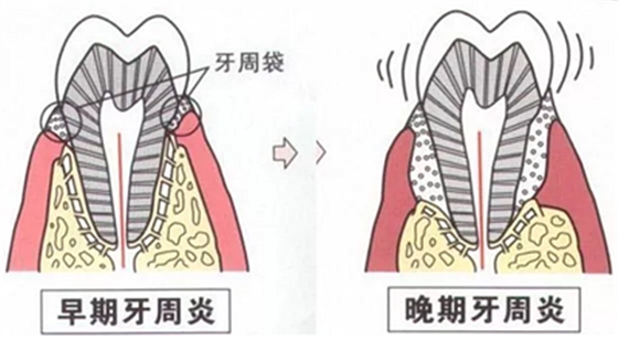 上海嘉福口腔研究所二十一世紀(jì)牙周病的臨床進(jìn)展