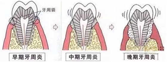 上海嘉?？谇谎芯克皇兰o(jì)牙周病的臨床進(jìn)展