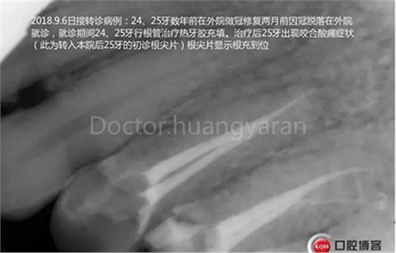 當根管治療遇見根尖骨穿孔 當根管治療遇見根尖骨穿孔