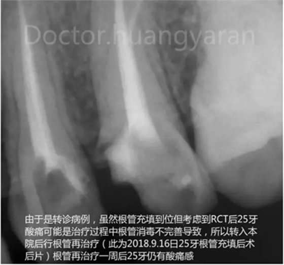 當根管治療遇見根尖骨穿孔 當根管治療遇見根尖骨穿孔