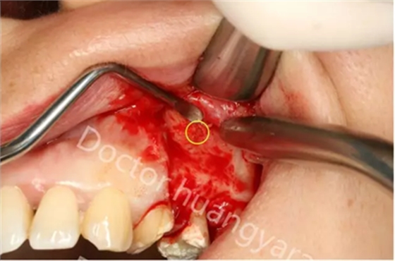 當根管治療遇見根尖骨穿孔 當根管治療遇見根尖骨穿孔