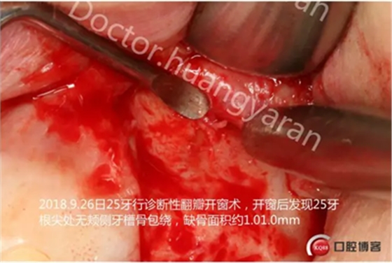 當根管治療遇見根尖骨穿孔 當根管治療遇見根尖骨穿孔