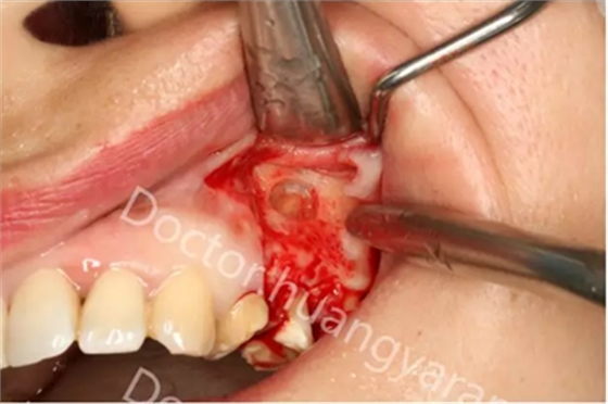 當根管治療遇見根尖骨穿孔 當根管治療遇見根尖骨穿孔