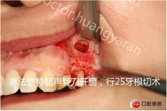 當根管治療遇見根尖骨穿孔 當根管治療遇見根尖骨穿孔