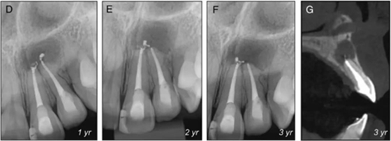 【病例分享】治療后的根尖周炎與根尖外的獨(dú)立感染