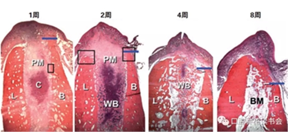 血液衍生物PRF&CGF在牙槽窩處理中的應用