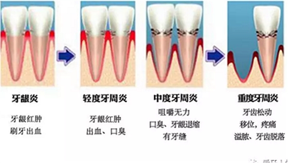 牙齦萎縮怎么辦？