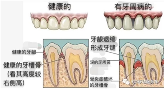 牙齦萎縮怎么辦？