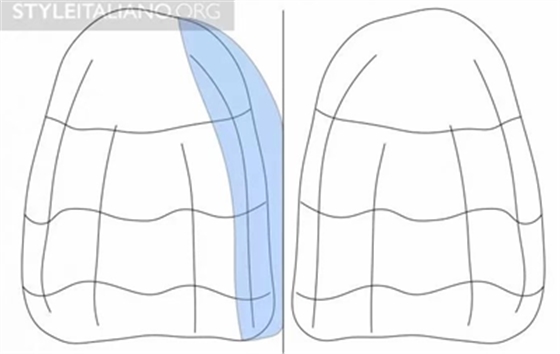 【分享】前翼技術關閉前牙間隙