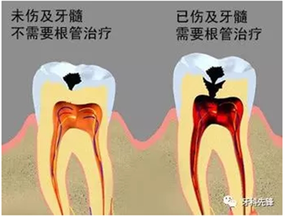 補(bǔ)牙不做冠，療效少一半！根管治療后牙齒已經(jīng)不疼了，為什么還要戴牙冠呢？