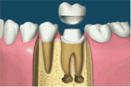 補(bǔ)牙不做冠，療效少一半！根管治療后牙齒已經(jīng)不疼了，為什么還要戴牙冠呢？